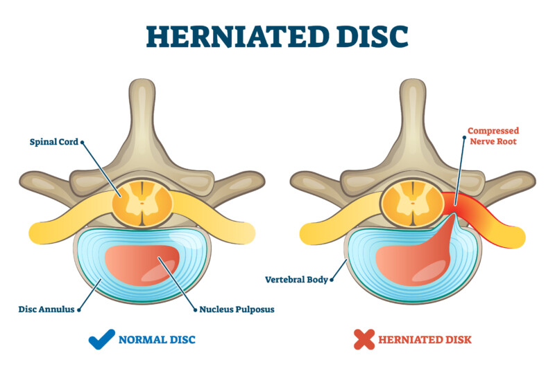 Vertebral Decompression Therapy Retracts Herniated Discs